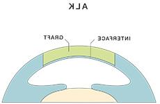 前板层角膜移植术（ALK）
