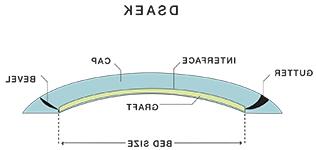 Descemet剥离内皮角膜移植术（DSAEK）