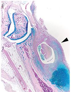 Severe Arthritis